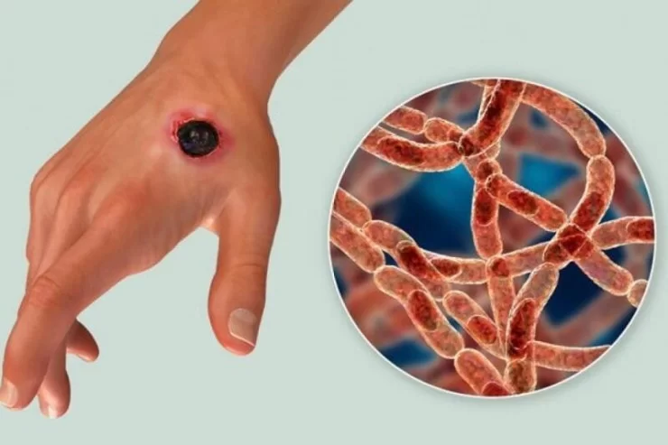 Zaqatalada daha 2 nəfər qarayaraya yoluxdu