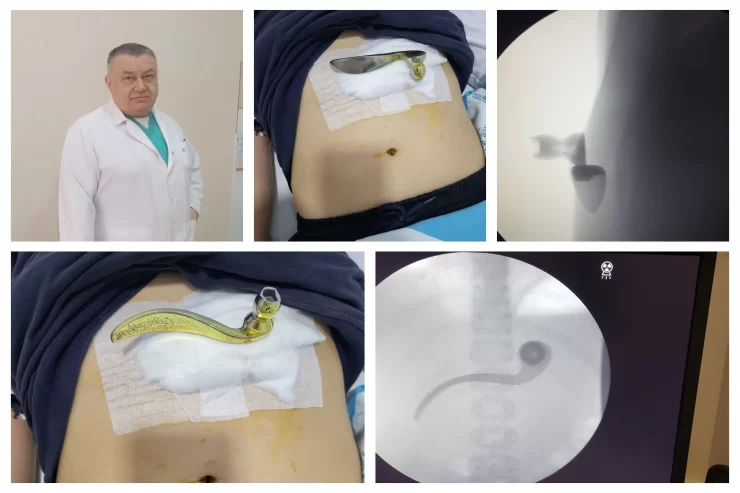 Bakıda dəhşətli hadisə - Uşağın qarnından QAPI DƏSTƏYİ ÇIXDI