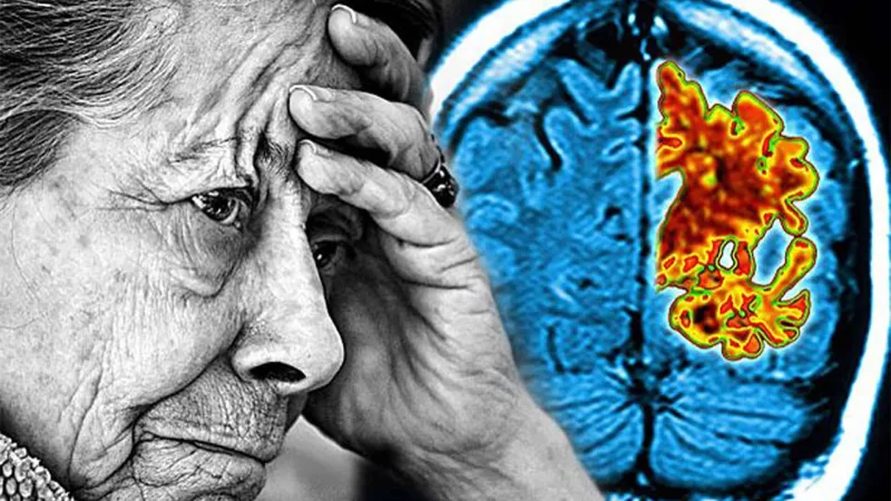 Dünyada Alzheimer xəstəliyinin yeni müalicə üsulları üzərində işlər sürətlənir
