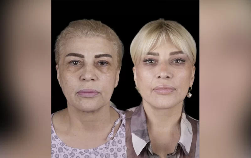 Mətanət İsgəndərli əməliyyatla belə dəyişdi - Fotolar